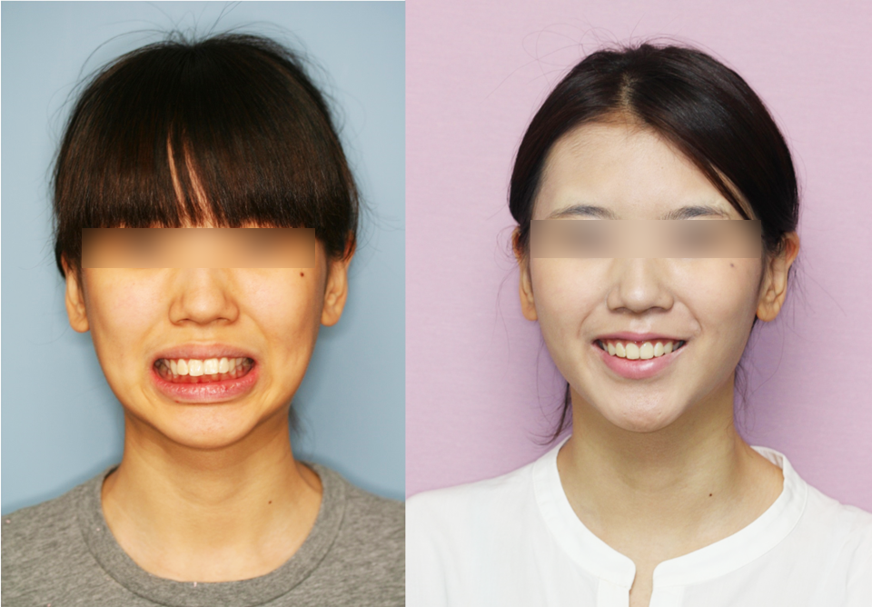 2급 부정교합 어린이 치료 사진