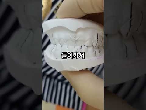 주걱턱 될 뻔한 아이, 3개월 만에 바뀐 치아..