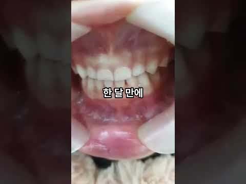 양악수술 걱정 끝! 만 4세 부정교합, 수술 없..