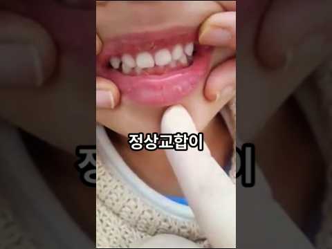 양악수술 걱정 마세요!