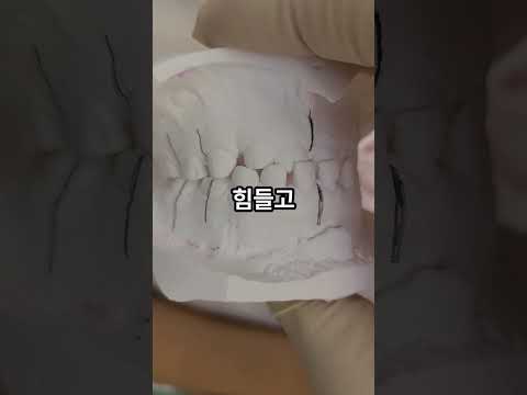 아래 치아가 위에 치아를 덮는 주걱턱, 프랑..