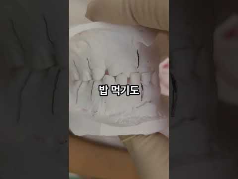 반대교합, 프랑켈 장치 하나로 정상교합!
