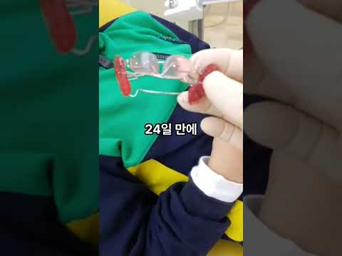 한 달 만에 정상 교합 된 비결은?